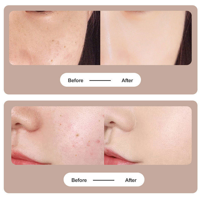 Plasma Skin Tag & Dark Spot Removal Beauty Pen - Marianas Artistry